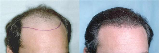 脱发影响形象，究竟怎样才能和脱发一刀两断？