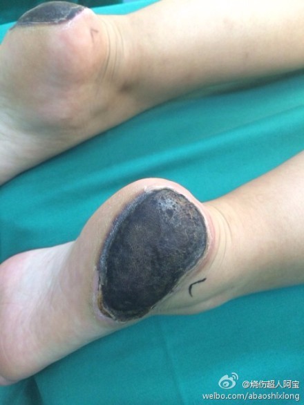 冬天取暖,谨防低温烫伤