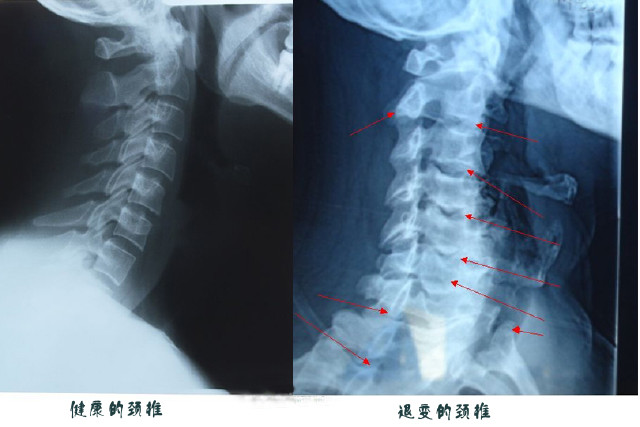 警惕丨35岁男子躺床上玩手机 颈椎退化如70岁