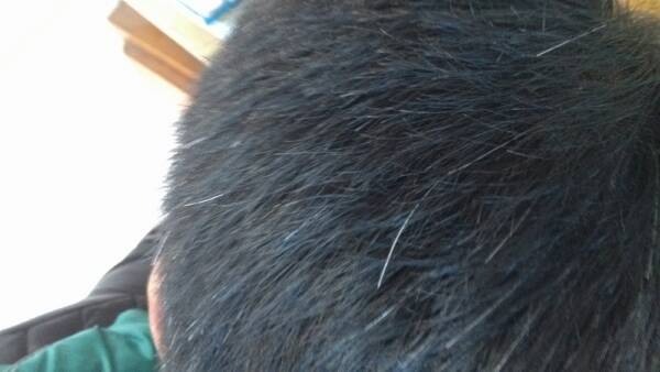 【问答】为什么熬夜会有黑眼圈?少白头是怎么