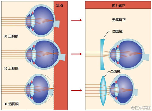 近视矫正手术的原理_从原理讲透彻 东莞全飞秒近视手术的利与弊