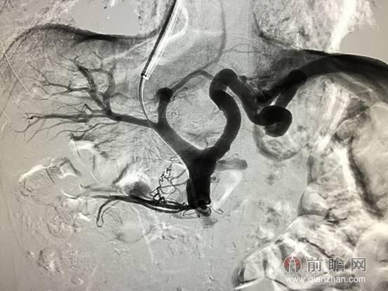 中山大学附属肿瘤医院首例经颈静脉肝内门体分