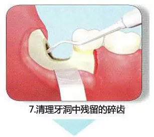 拔牙流程图,你们不懂这种痛!