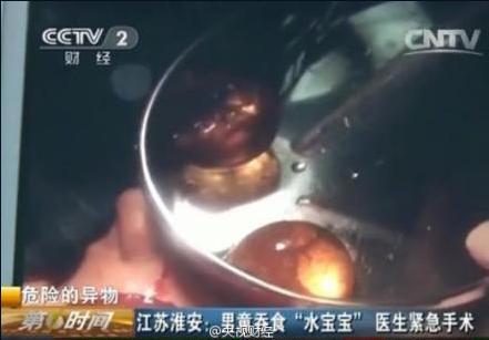 <em>男童</em>吞食水宝宝致肠穿孔 切除肠子获救(图)-没