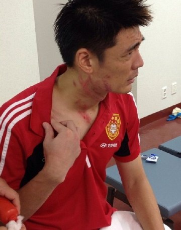 曾诚受伤史:亚冠国足关键战伤退 与队友相撞5处骨折