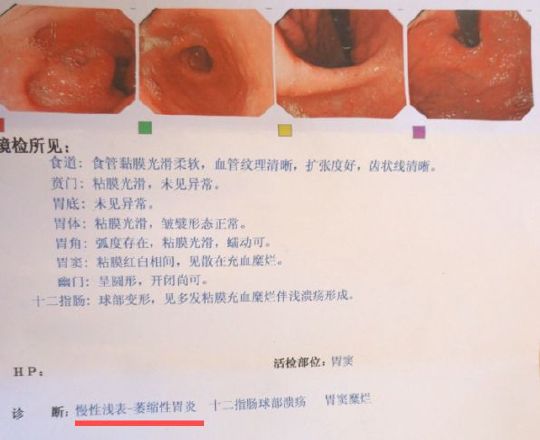 哪些胃病有可能会衍变成胃癌?胃溃疡胃炎都危险