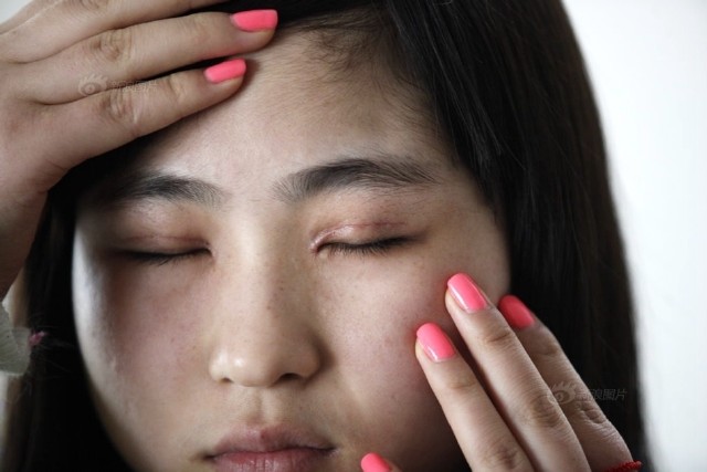 少女黑诊所割双眼皮留疤