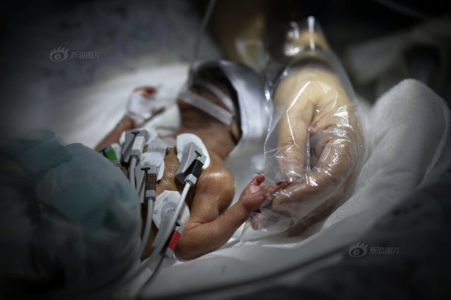 产妇生下袖珍女婴:体重1.3斤