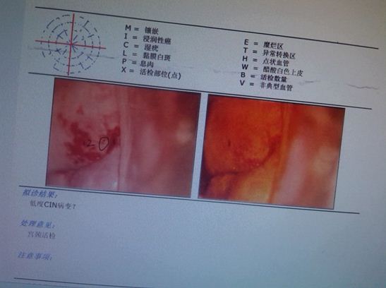 关注癌症健康：宫颈癌防治的新进展与科学认知